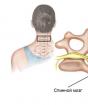 All information om Dikul övningar för osteokondros Dikul gymnastik för cervikal och lumbal osteokondros