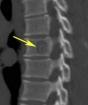Spinal hemangiom: orsaker, symtom, hur man behandlar, rekommendationer