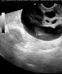 Tubal obstruktion eller hydrosalpinx: symtom och behandling