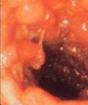 Sintomas at paggamot ng intestinal colitis sa mga bata Intestinal colitis sa isang bata