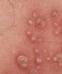 Mga sintomas at paggamot ng genital herpes sa mga kababaihan Paano gamutin ang genital herpes sa mga kababaihan