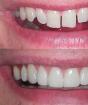 Avtagbara faner på tänderna: fördelar och nackdelar Hur man klär fanér på tänderna
