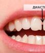 Hur fixar man klyftan mellan tänderna?