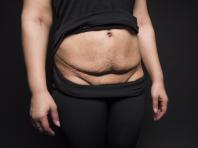 Hur man går ner i vikt efter ett kejsarsnitt och blir av med magen hemma - rätt kost och träning